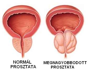 prostatitis 4 szakasz a prosztatitis gyakran a wc- hez megy