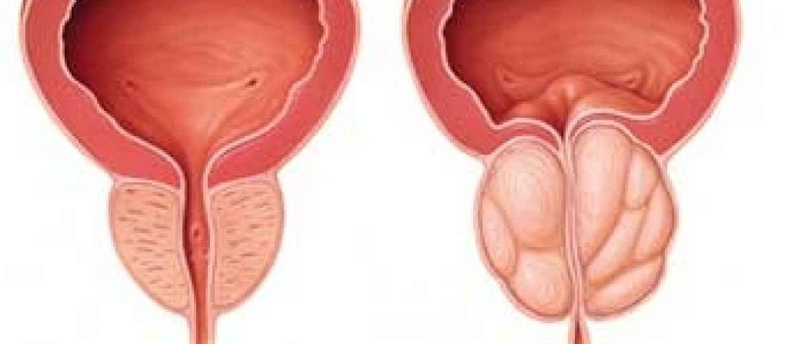 hogyan lehet megérteni hogy prosztatagyulladása van prostate adenocarcinoma cytokeratin
